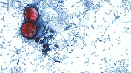 First two US deaths linked to diarrhea-inducing parasite confirmed